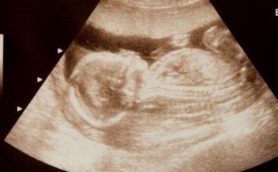 艾滋病做试管吃阻断药是否有用要早知，有无影响看完明白